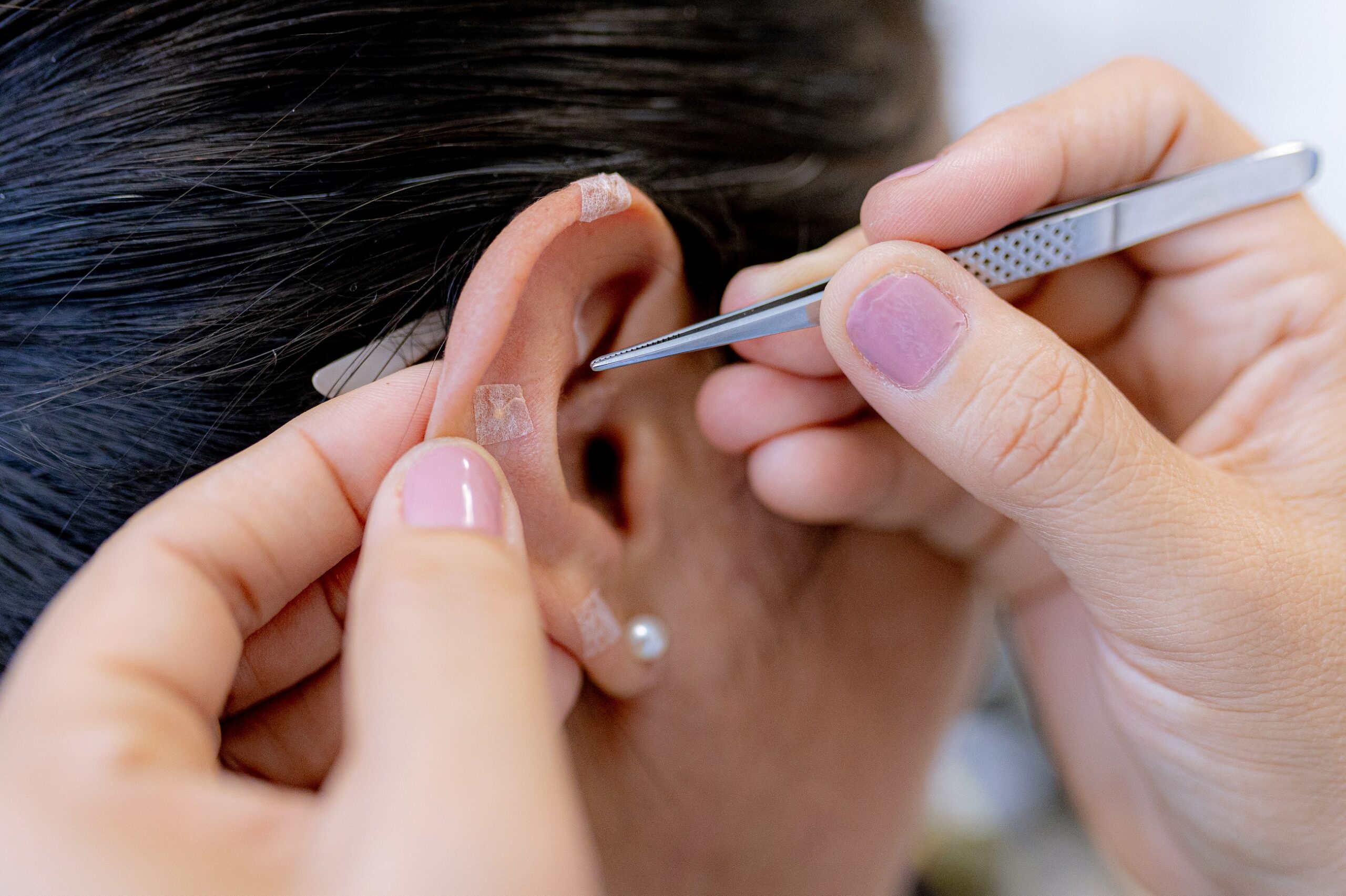 A imagem mostra uma pessoa a aplicar pequenos adesivos numa orelha. Estes adesivos parecem ser usados em acupuntura auricular, uma técnica de medicina tradicional chinesa. Uma pessoa está a usar pinças para colocar os adesivos em pontos específicos da orelha.