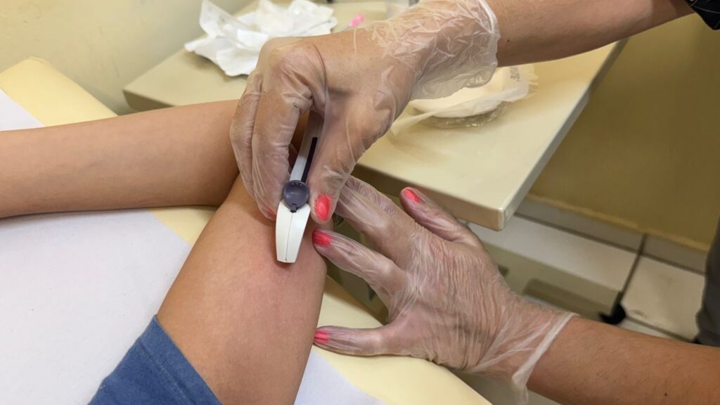 A imagem mostra uma cena em um ambiente clínico, onde uma pessoa está realizando um procedimento na pele do antebraço de outra pessoa. A pessoa que realiza o procedimento está usando luvas transparentes descartáveis, possivelmente de vinil ou nitrilo, e segura um dispositivo médico branco com um botão deslizante roxo. O braço da pessoa que recebe o procedimento é claro e está apoiado sobre uma superfície branca, provavelmente uma maca ou bancada de exame. O profissional tem as unhas pintadas de rosa ou coral, visíveis através das luvas. O ambiente é bem iluminado, com piso de azulejos claros e uma atmosfera limpa e organizada, típica de um consultório ou clínica médica. A imagem transmite um contexto de cuidado e exame médico, possivelmente um teste de alergia, coleta de amostra ou aplicação de algum tratamento tópico.
